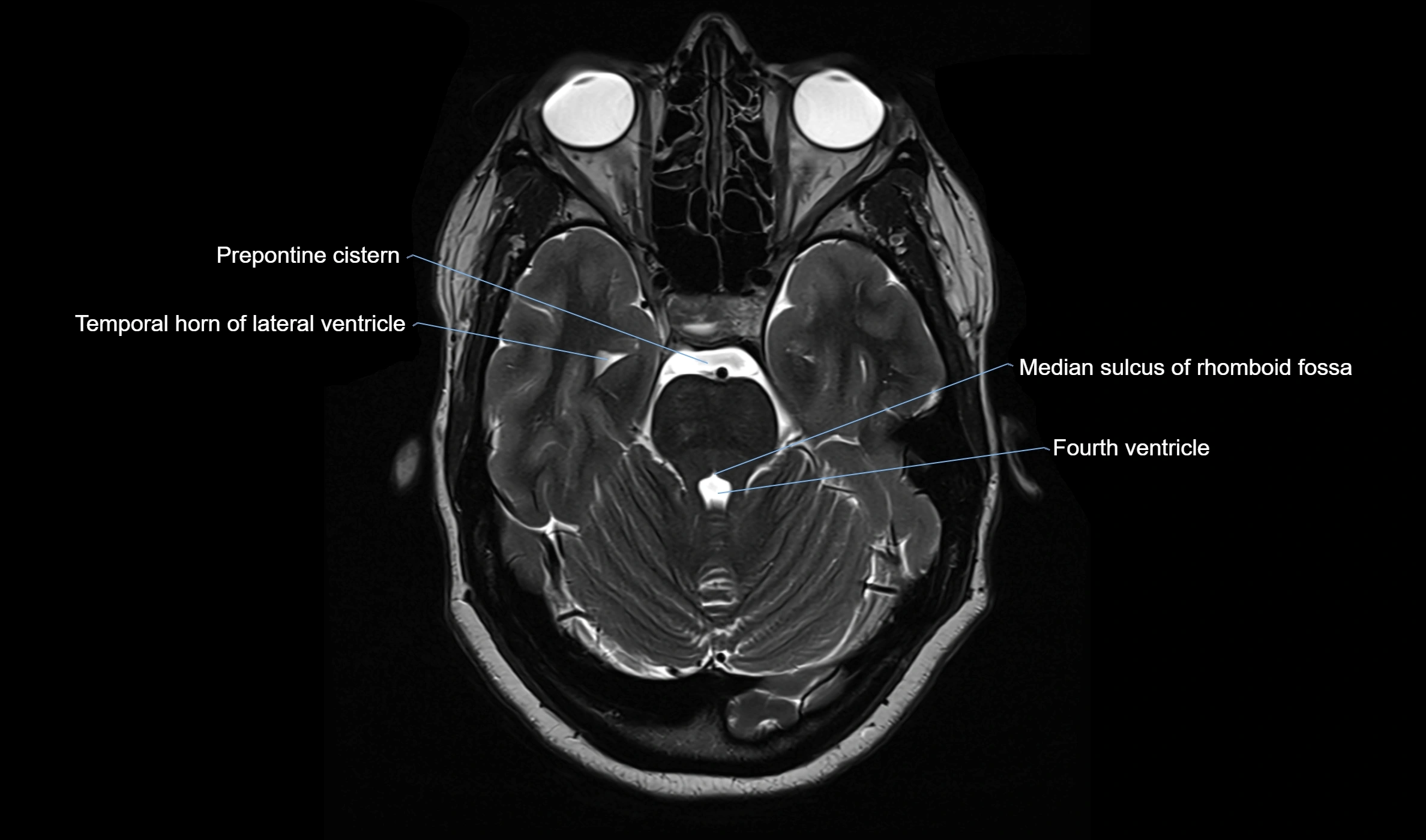 Brain cisterns  and ventricles  axial anatomy 3T MRI image-img-00001-00017.webp
